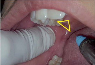 Tecnica adaptada para anestesiar el nervio alveolar mandibular con éxito