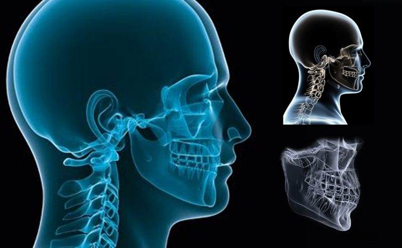 Fracuras del macizo craneal. Un reporte clínico