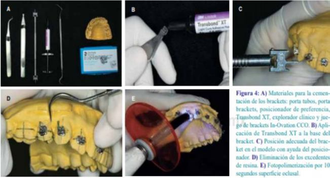 Protocolo de cementación indirecta de aparatología ortodóncica fija utilizando materiales de uso común
