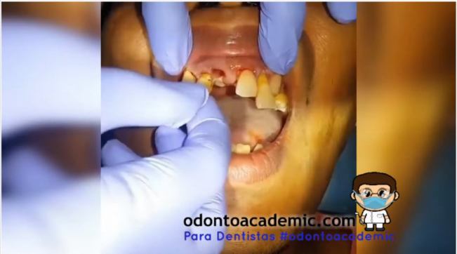 Extracciones dentales múltiples por enfermedad periodontal