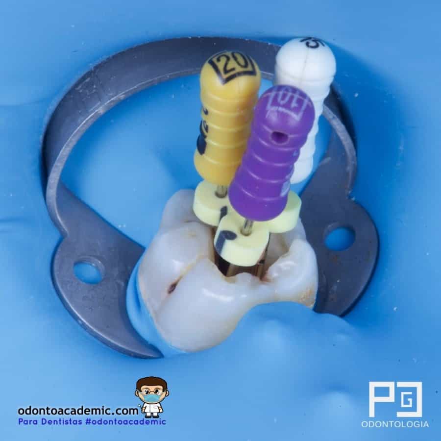 Endodoncia Primer Molar Inferior 3 Conductos