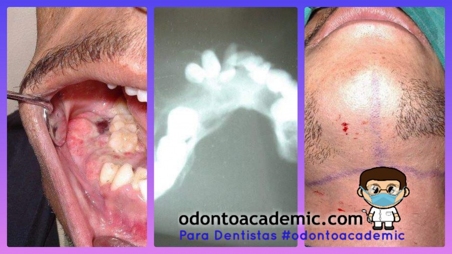 Enucleación de Tumor Odontogénico