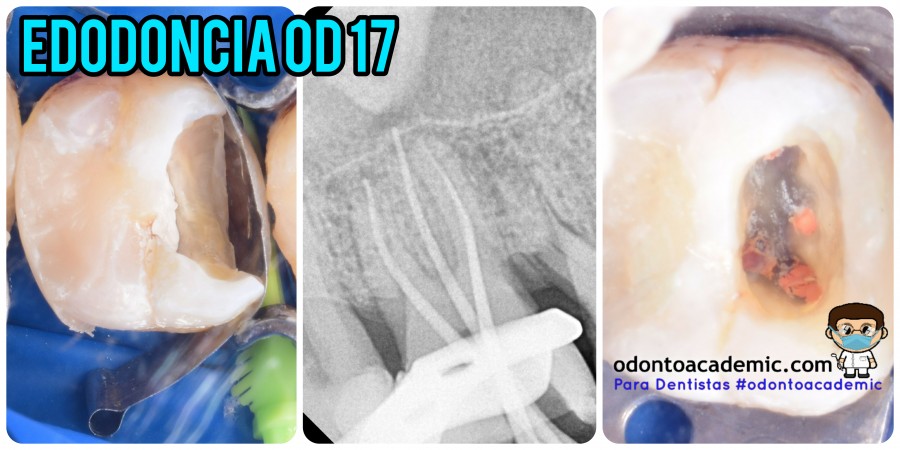 Endodoncia OD 17