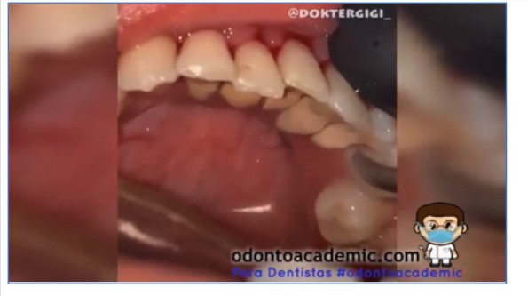 Eliminación de sarro dental mediante escariador, ultrasonido