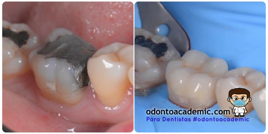 Cambio de restauración de Amalgama:  Endodoncia e Incrustación Estética elaborada con escaner y fresadora.