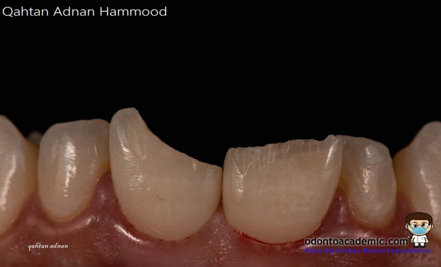 Fractura dental Dientes incisivos centrales superiores