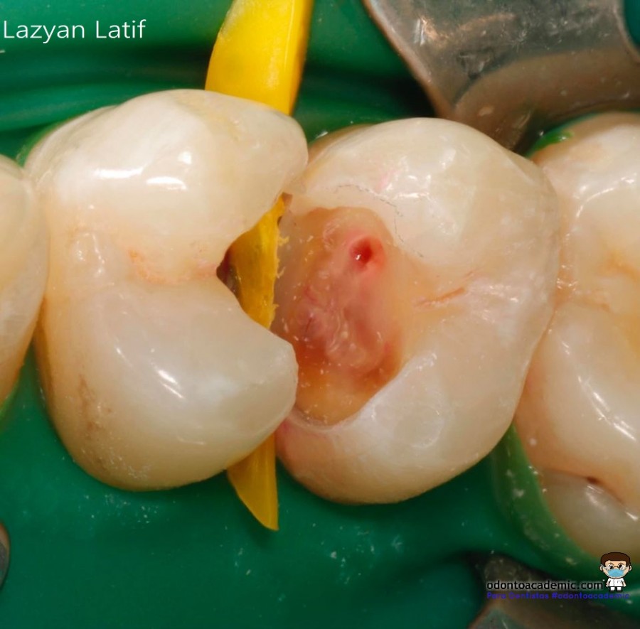 Caries interproximal (Restauración premolares)