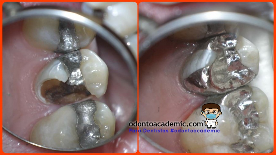 Restauración dentaria de Amalgama