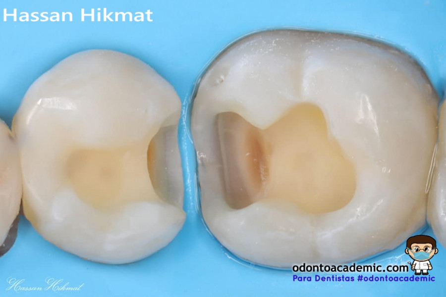 Incrustación dental  estética con sistema matriz: Molar & Premolar