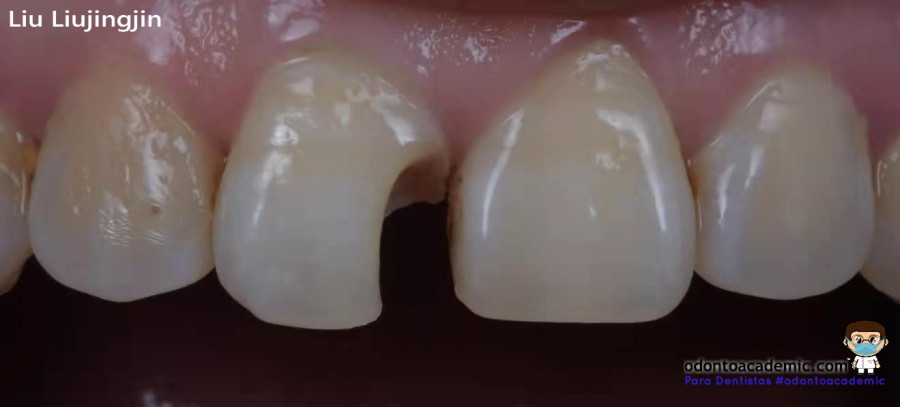 Restauración de dientes anteriores  con resina dental