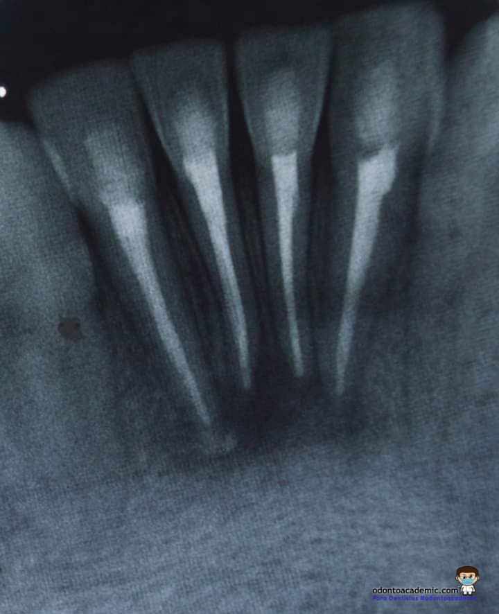 Prótesis dentales gravitaciones, una opcion a pacientes sin hueso alveolar
